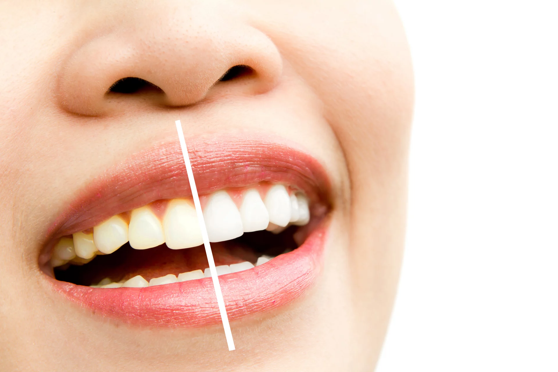 professionelles bleaching, zähne aufhellen bei Elbdental Zahnarztpraxis in Dresden.